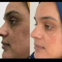 جوانسازی با پی آرپی و لایه برداری پوست  فقط۳۹۹