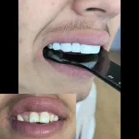 کامپوزیت دندان|خدمات آرایشگری و زیبایی|دورود, |دیوار