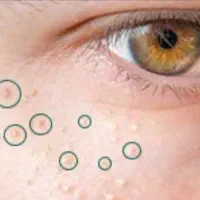 جشنواره شیدینگ لب و ریموو تاتوهای قدیمی صورت|خدمات آرایشگری و زیبایی|همدان, |دیوار