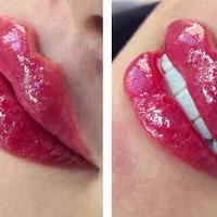 تزریق ژل فیلر بوتاکس مزو و لیزر در کلینیک زیبایی