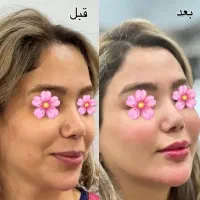 بوتاکس ژل فیلر