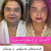تخفیف طلایی بوتاکس و مزوتراپی|خدمات آرایشگری و زیبایی|تهران, جماران (نیاوران)|دیوار