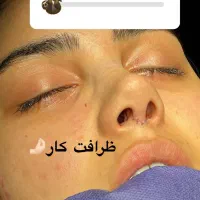 آف زیبایی لیپو ابدو عمل بینی ۱۹ میلیون|خدمات آرایشگری و زیبایی|خرمشهر, |دیوار