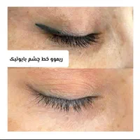 ریمووتتو با اشانتیون بن مژه دائم در کلینیک زیبایی|خدمات آرایشگری و زیبایی|تهران, تهرانپارس غربی|دیوار