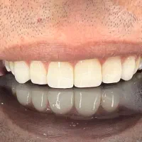 درمان دندان با شرایط دلخواه + ویزیت رایگان|خدمات آرایشگری و زیبایی|مشهد, منزل آباد|دیوار
