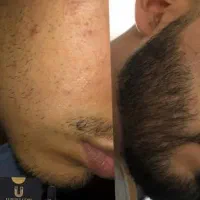 رویش پرپشت ریش