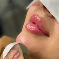 بوتاکس مزو جوانسار آنزیم بینی فیلر فقط ۷۵۰