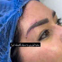 جراحی لیفت ابرو،دایرکت ابرو،لیفت شقیق ،پیشانی|خدمات آرایشگری و زیبایی|تهران, پاسداران|دیوار