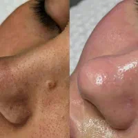 تخفیف یلدایی پاکسازی پوست فقط ۵۰۰تومن