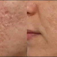 تزریق تمام اقساط بدون پیش پرداخت ژل،بوتاکس،مزو|خدمات آرایشگری و زیبایی|قم, بکایی|دیوار