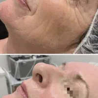 لیزر co2تک جلسه ای،تزریق چربی ودیگر خدمات زیبایی|خدمات آرایشگری و زیبایی|یاسوج, |دیوار