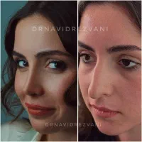 جراحی بینی فقط ۳۴ میلیون