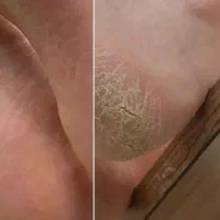 پدیکور با تخفیف ویژه به مدت محدود