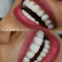 اموزش دندان سازی .ثابت ومتحرک وکامپوزیت