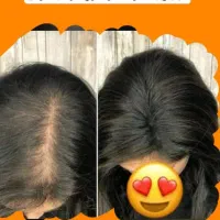 درمان ریزش مو،مژه ،ابر،وها وپو،ست