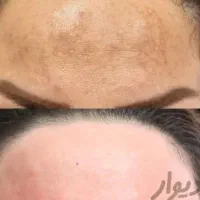 حذف تاتو با لیزر کیوسوئیچ و روشن کننده بیکینی صورت