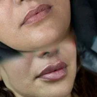 تزریقات زیبایی کلینیک زیبایی لاراتیس