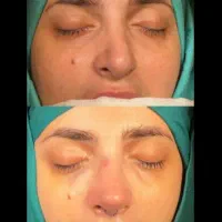 جراحی بینی با بیمه توسط متخصص گوش ،حلق،بینی|خدمات آرایشگری و زیبایی|تهران, جهاد|دیوار
