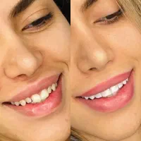 پیکرتداشی/عمل بینی/کامپوزیت دندان