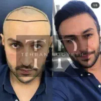 جشنواره کاشت مو ، ابرو و ریش (۴۰٪ تخفیف)