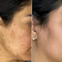 ضدلک بیوممتیک جهانی