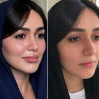 نیازمند مدل فیلر لب/زیرچشم/بوتاکس/گونه/زاویه