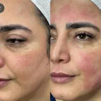 هایفوتراپی رفع چین و چروک پوست با بروزترین تجهیزات|خدمات آرایشگری و زیبایی|شیراز, قدوسی غربی|دیوار