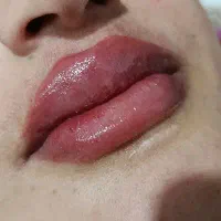 تزریق ژل و بوتاکس