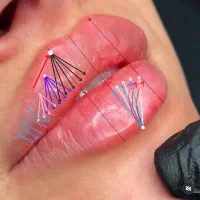 تزریق فیلر تخفیف هفتگی