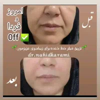 جوانسازی ژل و مزوژل و..|خدمات آرایشگری و زیبایی|برازجان, |دیوار