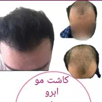 کاشت مو . کاشتمو کرمانشاه