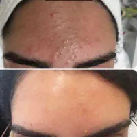 افر ویژه روز دختر خدمات فیشال تخصصی در کلینیک پوست