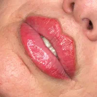بوتاکس-ژل-نخ و تمامی جراحی های زیبایی توسط متخصص
