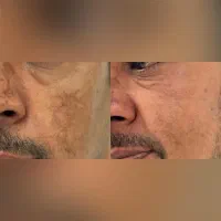 مزوتراپی &  PRP|خدمات آرایشگری و زیبایی|بندر انزلی, شاکوچه|دیوار