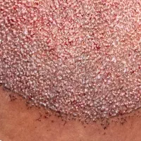 کاشت مو در شیراز فول تراکم و تضمینی