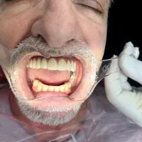 اوردنچر ایمپلنت کره اقساط ۵ ماهه واحدی۲۷میلیون