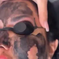 لیزر تضمینی موهای زائد رفع لک روشن کننده