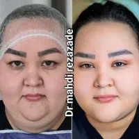 تخفیف ویژه، ساکشن تزریق چربی بلفارو کانتو اپیکانتو|خدمات آرایشگری و زیبایی|مشهد, هفت تیر (حافظ)|دیوار