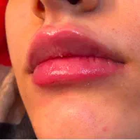 خدمات ژل فیلر بوتاکس|خدمات آرایشگری و زیبایی|هشتگرد, هشتگرد قدیم|دیوار
