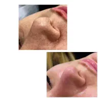 پاکسازی پوست با تخفیف خاص ک مختص شماست،دراسلامشهر