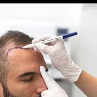 کاشت مو و ابرو بابالترین تراکم