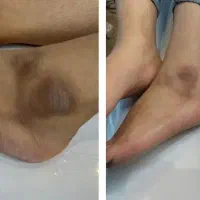 روشن سازی بیکینی وزیربغل