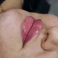 تزریق ژل ،فیلر بوتاکس مزو آنزیم خال برداری|خدمات آرایشگری و زیبایی|الیگودرز, |دیوار