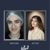 جراحی بینی با شرایط ویژه