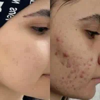 بهبودی علائم کبد چرب و معده