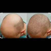 کاشت مو وابرو ژل وبوتاکس وساکشن چربی