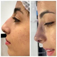 جراحی بینی  تیپ پلاستی لیفت بدون تامپون