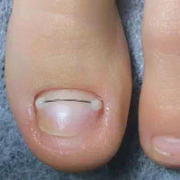 خارج کردن ناخن از داخل گوشت  و نصب ارتونیل|خدمات آرایشگری و زیبایی|مشهد, شهرک امام هادی (شهرک غرب)|دیوار