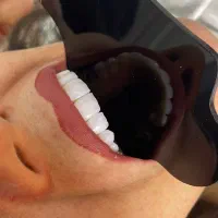 کامپوزیت لمینیت دندان