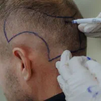 کاشت مو، ابرو، ریش، پی ار پی و مزوتراپی تضمینی